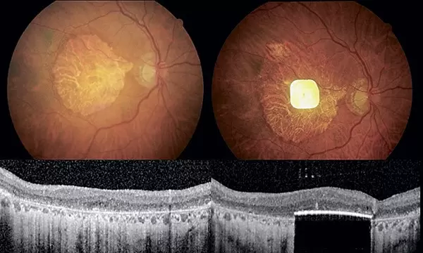 ЗАПЛАТКА ДЛЯ СЕТЧАТКИ